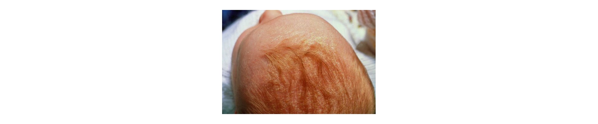 Cradle Cap