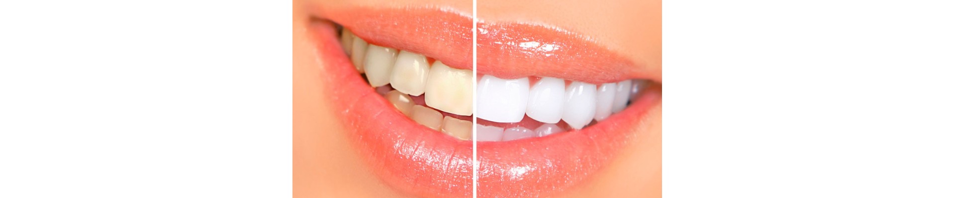 Teeth Whitening