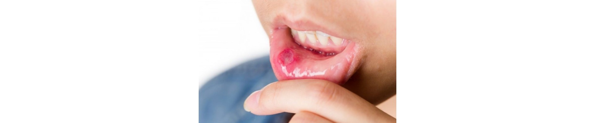Mouth Care & Sores