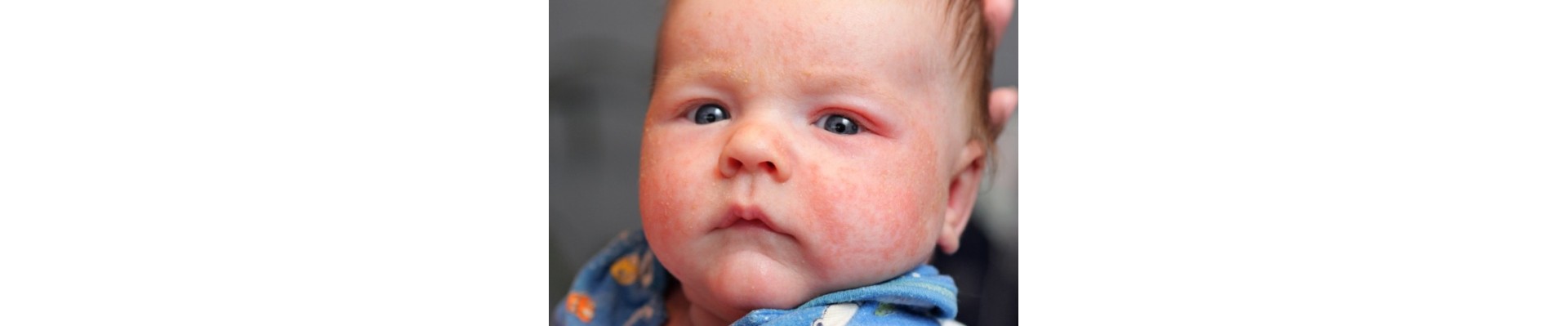 Atopic Dermatitis