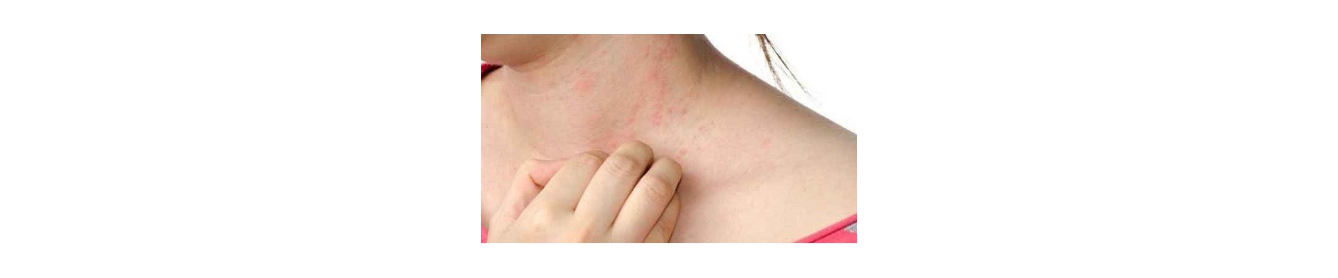 Eczema