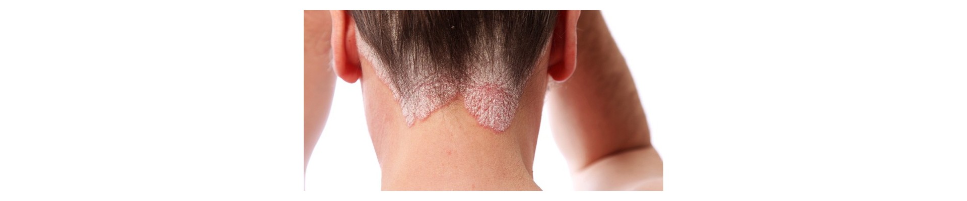 Psoriasis