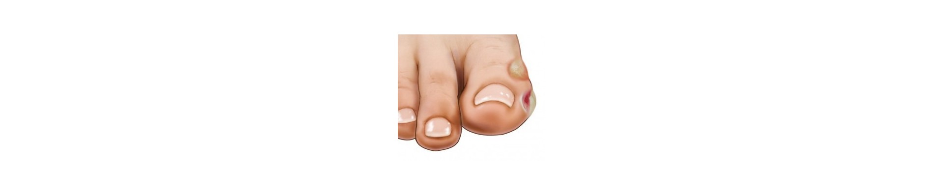 Calluses & Blisters