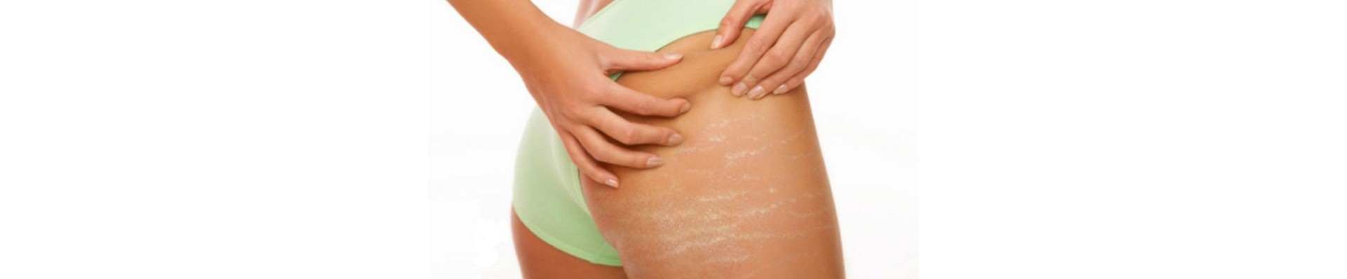 Stretch Marks 